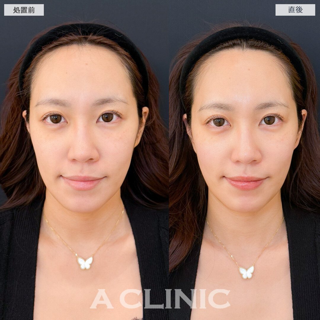 XERF(ザーフ)で肌が引き締まりハリツヤがアップしました！処置前と直後の症例です(30代女性)