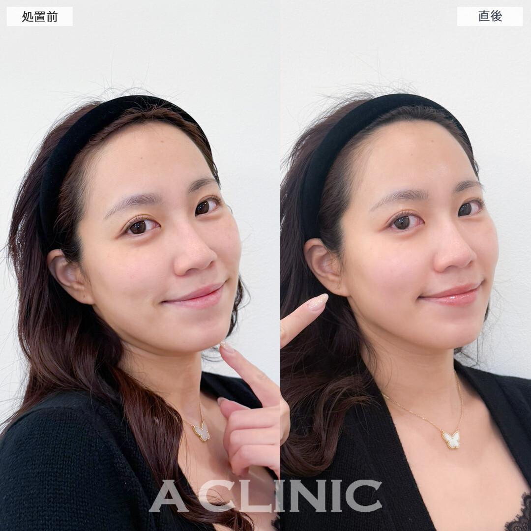 XERF(ザーフ)で肌が引き締まりハリツヤがアップしました！処置前と直後の症例です(30代女性)