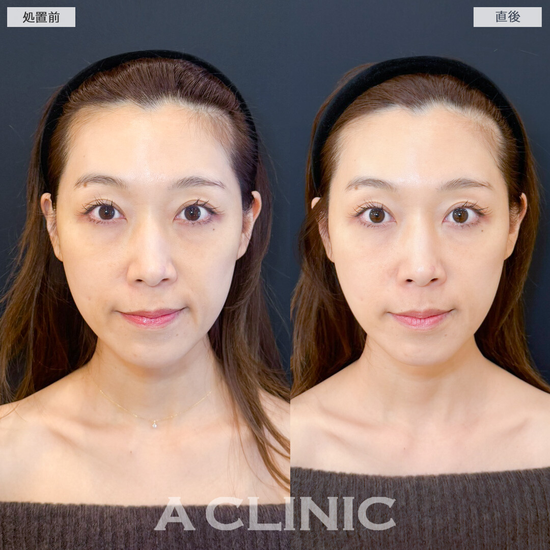 XERF(ザーフ)で即時に肌にハリ感を感じました！処置前と直後の症例です(40代女性)