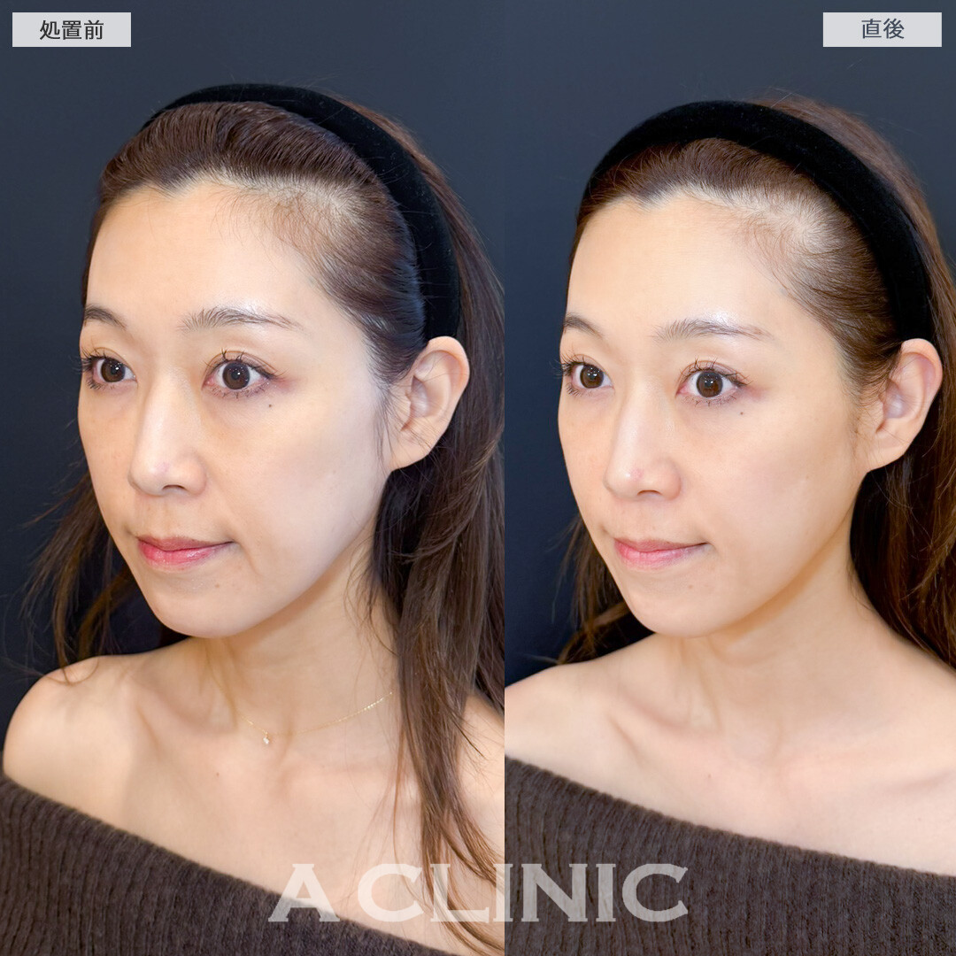 XERF(ザーフ)で即時に肌にハリ感を感じました！処置前と直後の症例です(40代女性)