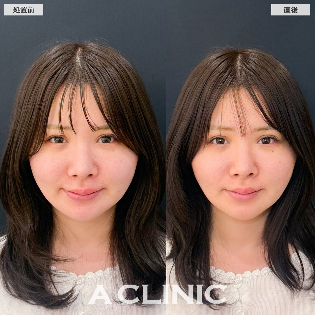 XERF(ザーフ)で痛み少なくたるみをしっかり引き上げました！こちら処置前と直後の症例です(30代女性)