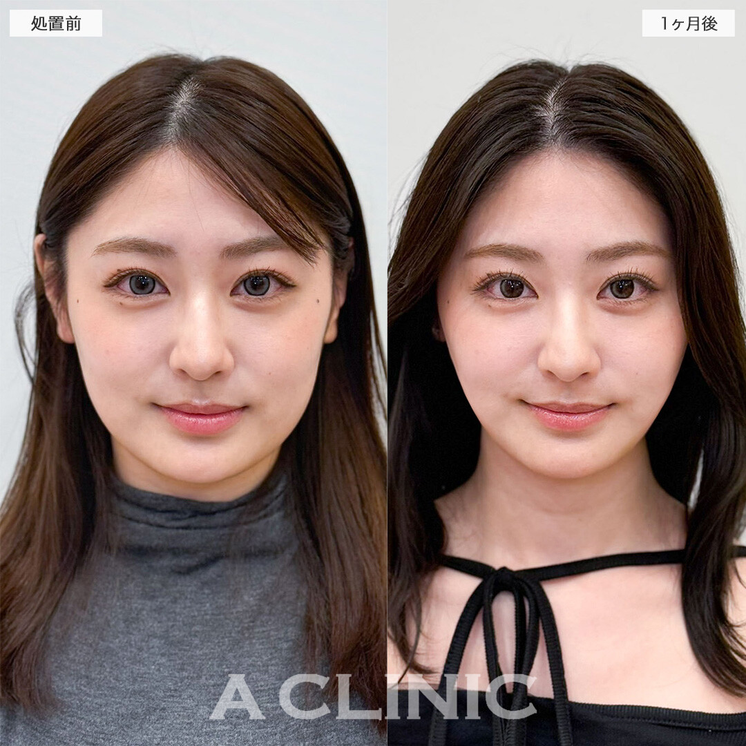 1day小顔脂肪吸引と小顔エラボトックスで輪郭のお悩みへ徹底的にアプローチ！こちら処置前と1ヶ月後の症例です(20代女性)