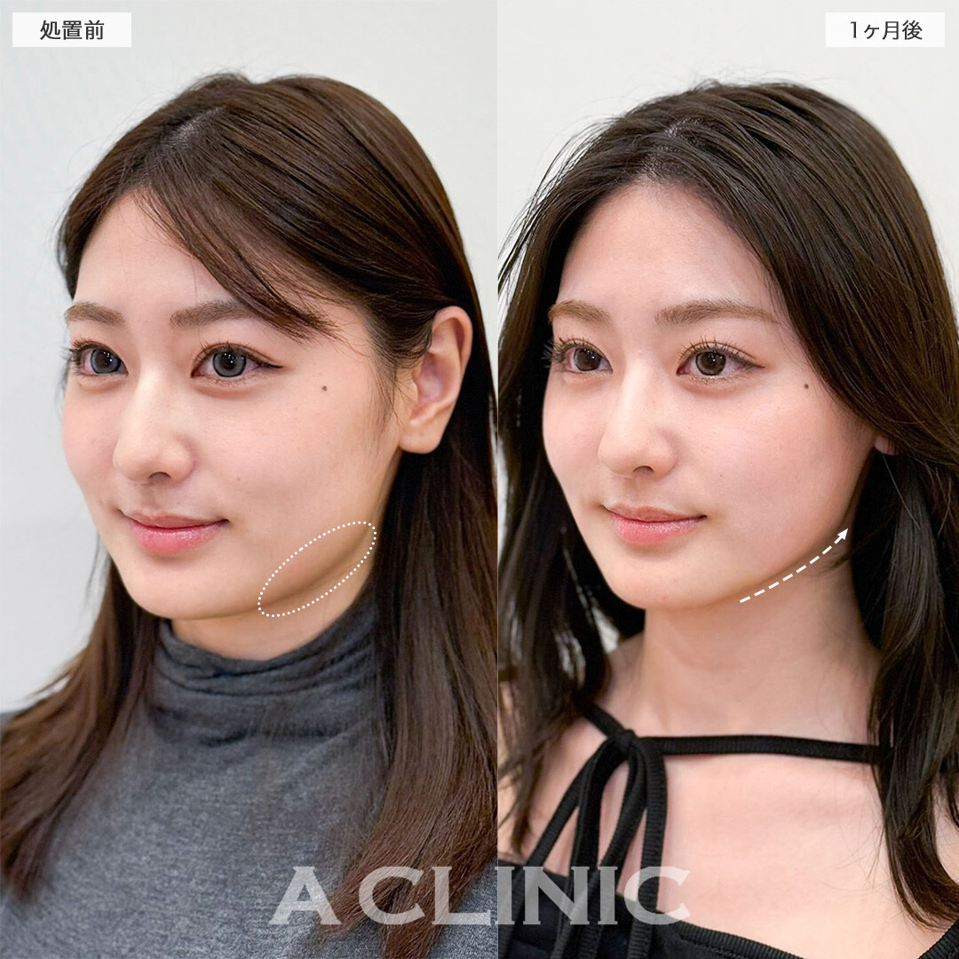 1day小顔脂肪吸引と小顔エラボトックスで輪郭のお悩みへ徹底的にアプローチ！こちら処置前と1ヶ月後の症例です(20代女性)