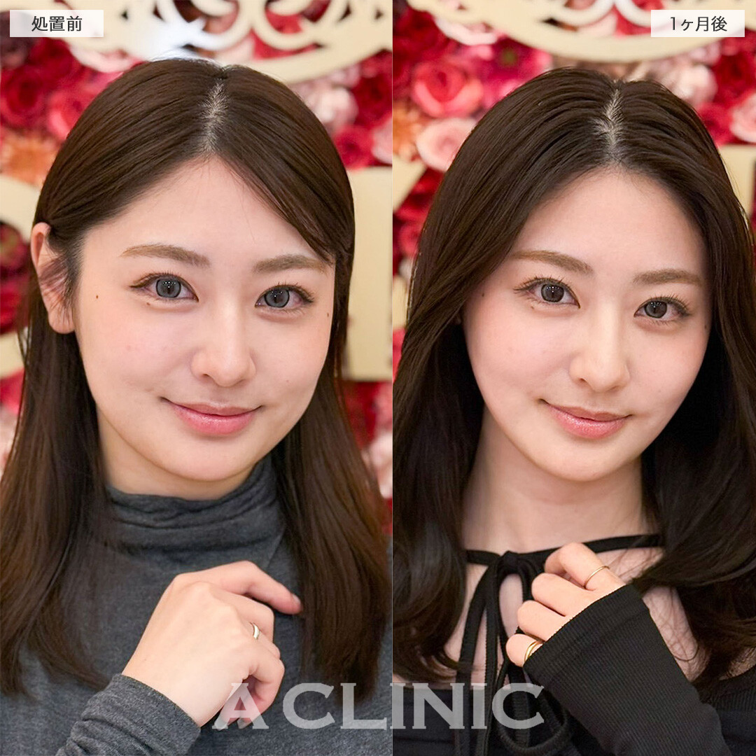 1day小顔脂肪吸引と小顔エラボトックスで輪郭のお悩みへ徹底的にアプローチ！こちら処置前と1ヶ月後の症例です(20代女性)