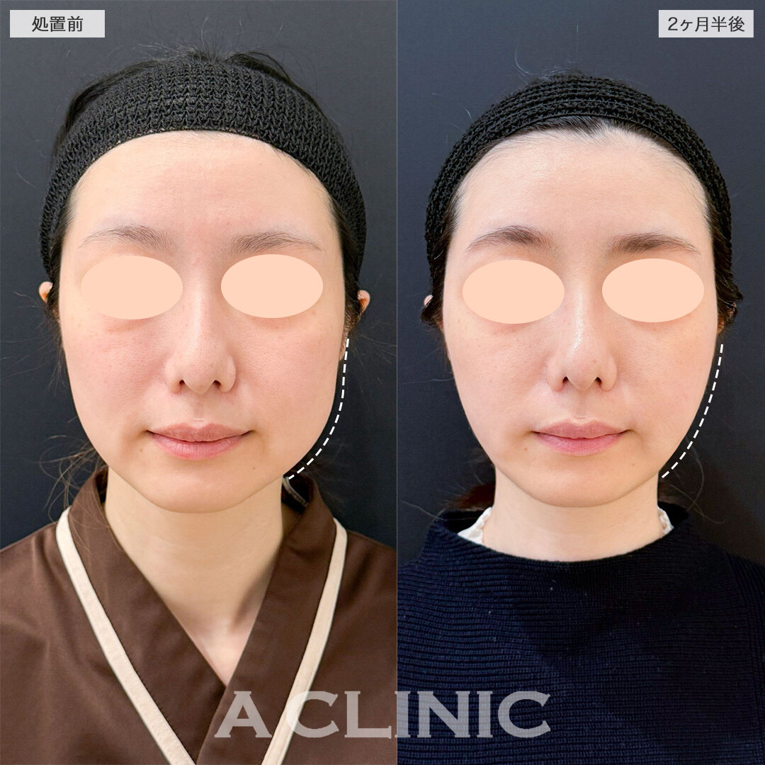 1day小顔脂肪吸引とバッカルファット除去術で脂肪による輪郭の凹凸を無くし滑らかなフェイスラインへ！こちら処置前と2ヶ月半後の症例です(30代女性)