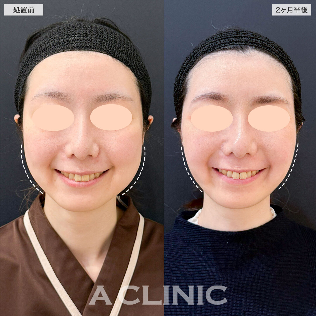 1day小顔脂肪吸引とバッカルファット除去術で脂肪による輪郭の凹凸を無くし滑らかなフェイスラインへ！こちら処置前と2ヶ月半後の症例です(30代女性)