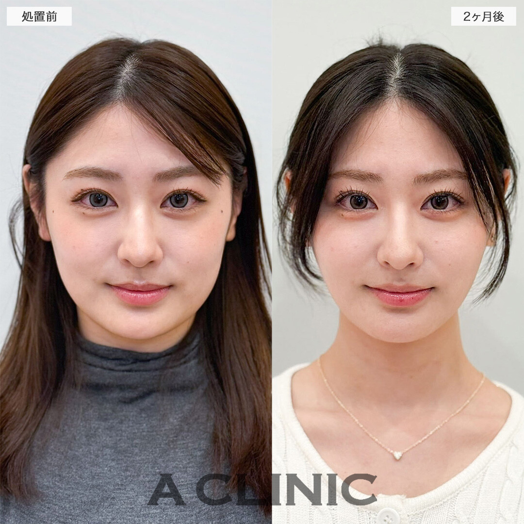 1day小顔脂肪吸引と小顔エラボトックスで元々の骨格が際立つ美しい輪郭へ！こちら処置前と2ヶ月後の症例です(20代女性)