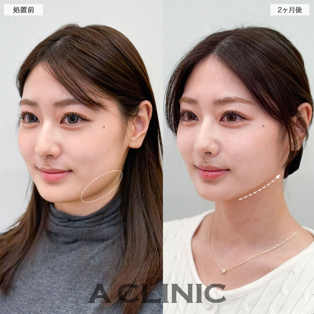 1day小顔脂肪吸引と小顔エラボトックスで元々の骨格が際立つ美しい輪郭へ！こちら処置前と2ヶ月後の症例です(20代女性)