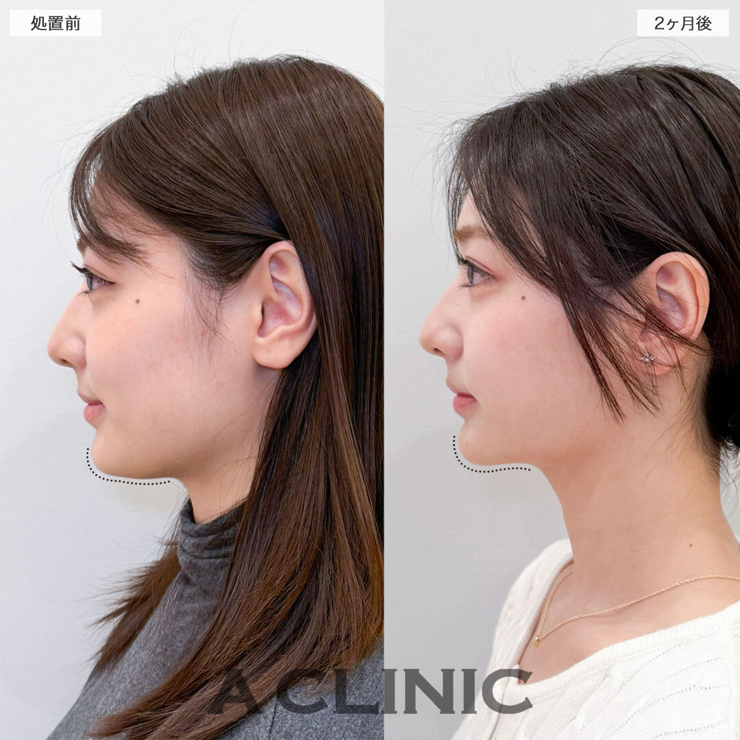1day小顔脂肪吸引と小顔エラボトックスで元々の骨格が際立つ美しい輪郭へ！こちら処置前と2ヶ月後の症例です(20代女性)