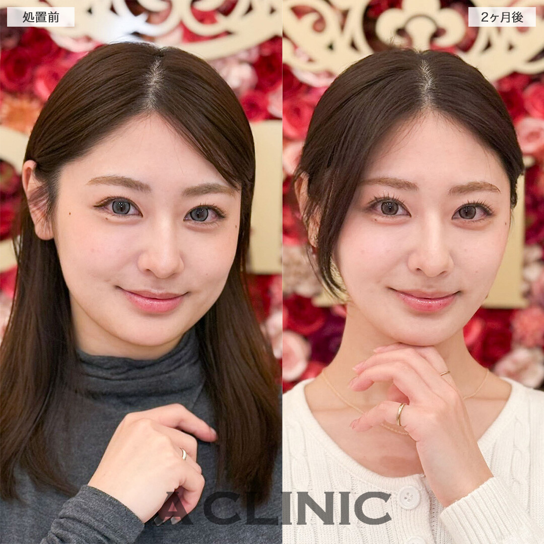 1day小顔脂肪吸引と小顔エラボトックスで元々の骨格が際立つ美しい輪郭へ！こちら処置前と2ヶ月後の症例です(20代女性)