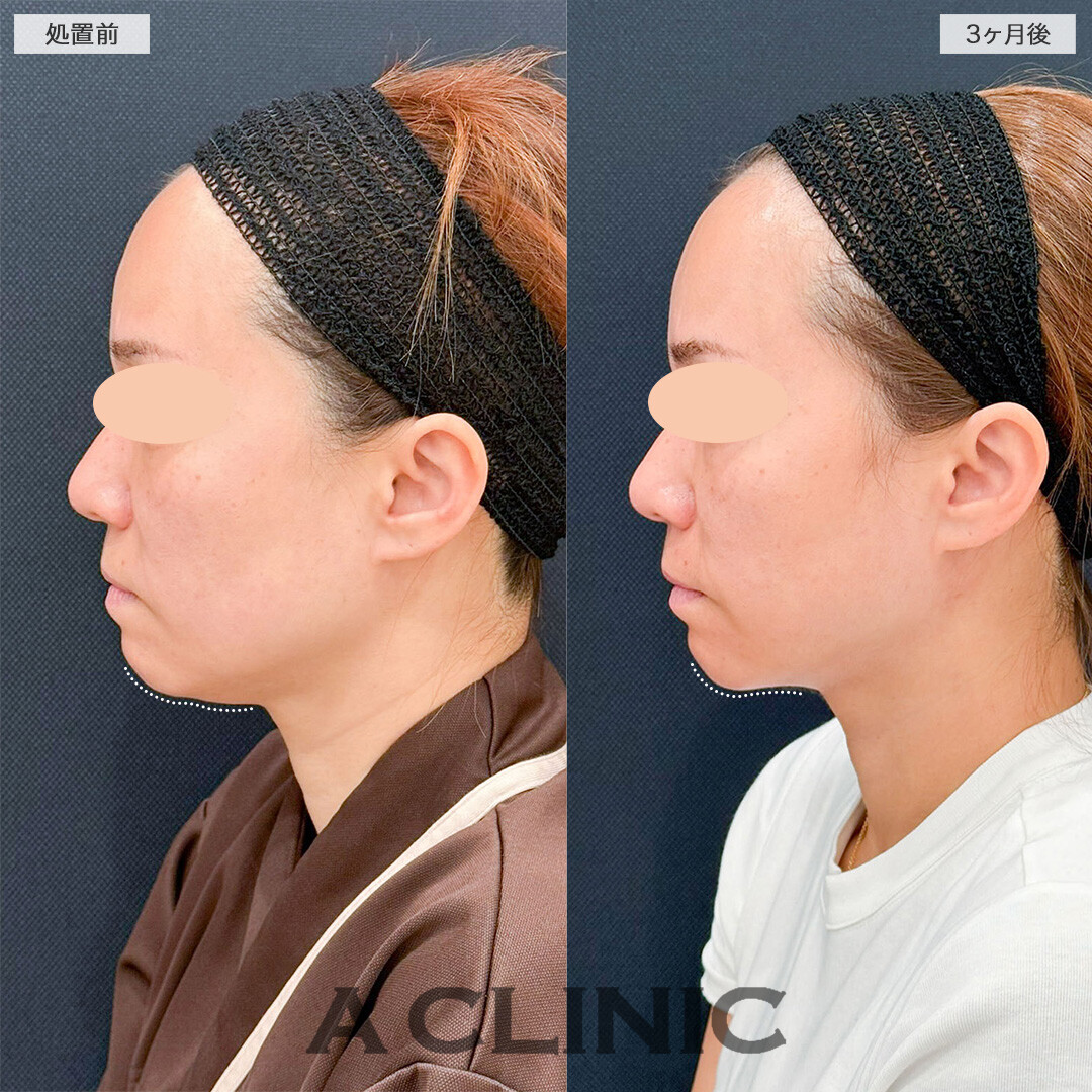 1day小顔脂肪吸引で口元のもたつきが解消し若返りに成功しました！こちら処置前と3ヶ月後の症例です(40代女性)