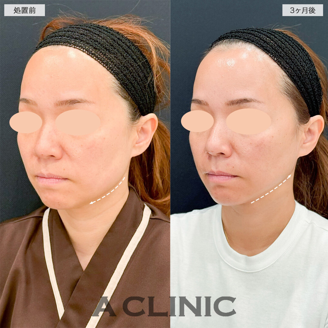 1day小顔脂肪吸引で口元のもたつきが解消し若返りに成功しました！こちら処置前と3ヶ月後の症例です(40代女性)