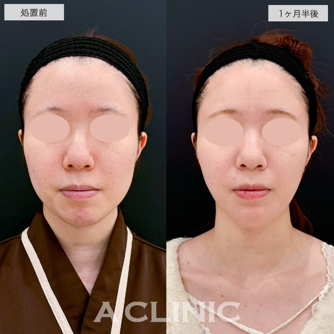 1day小顔脂肪吸引とあごへのヒアルロン酸注入で品よくスッキリした輪郭に!こちら処置前と1ヶ月半後の症例です(20代女性)