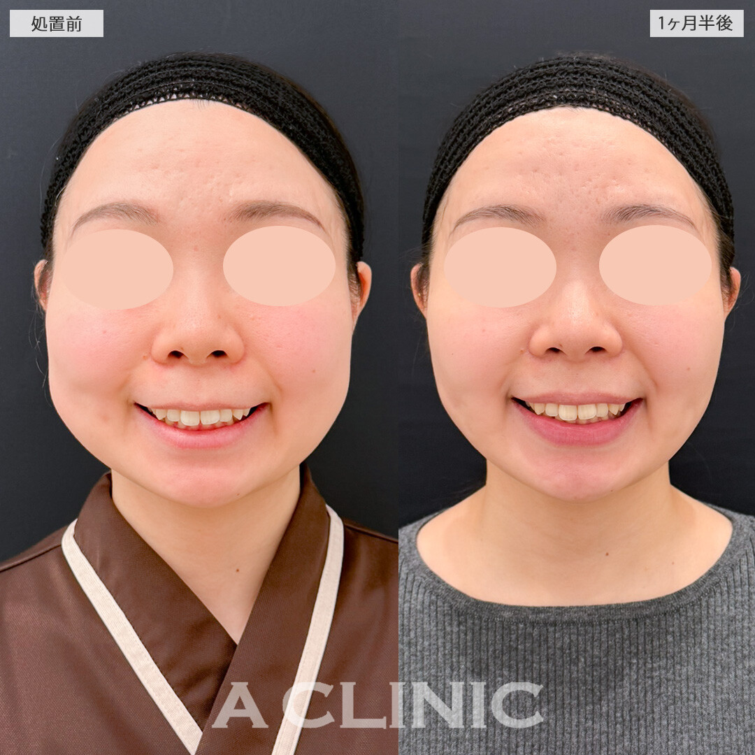 1day小顔脂肪吸引とバッカルファット除去術と小顔エラボトックスでお顔の面積を大幅にカットできました！処置前と1ヶ月半後の症例です(30代女性)