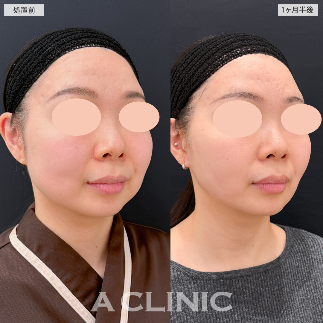 1day小顔脂肪吸引とバッカルファット除去術と小顔エラボトックスでお顔の面積を大幅にカットできました！処置前と1ヶ月半後の症例です(30代女性)