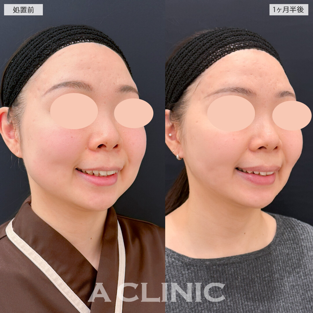 1day小顔脂肪吸引とバッカルファット除去術と小顔エラボトックスでお顔の面積を大幅にカットできました！処置前と1ヶ月半後の症例です(30代女性)