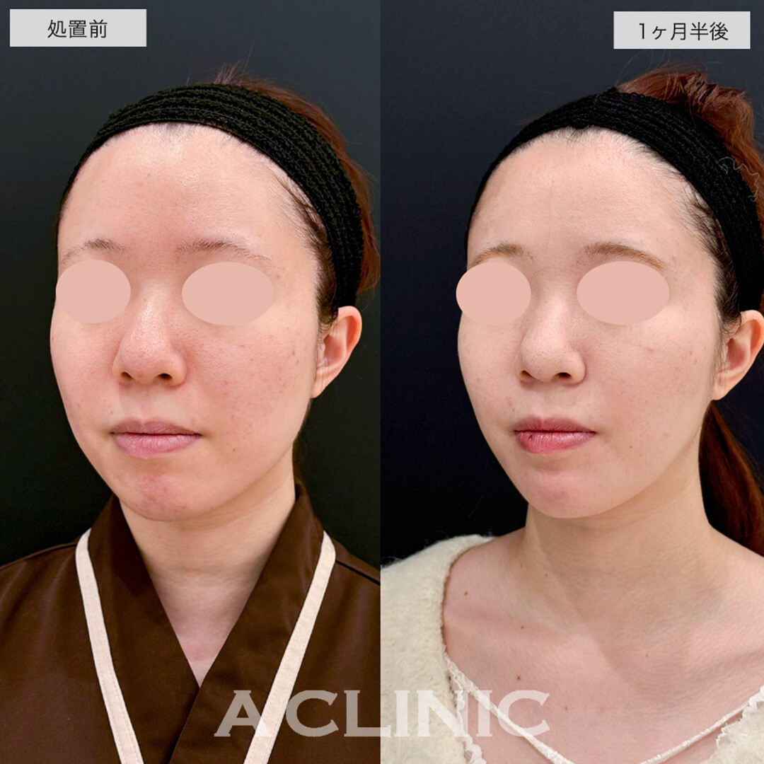 1day小顔脂肪吸引とあごへのヒアルロン酸注入で品よくスッキリした輪郭に!こちら処置前と1ヶ月半後の症例です(20代女性)