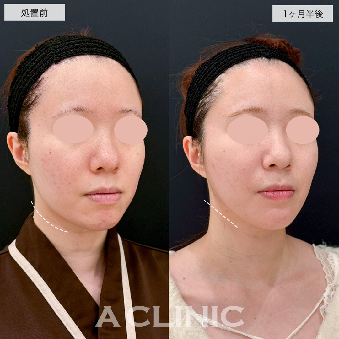 1day小顔脂肪吸引とあごへのヒアルロン酸注入で品よくスッキリした輪郭に!こちら処置前と1ヶ月半後の症例です(20代女性)