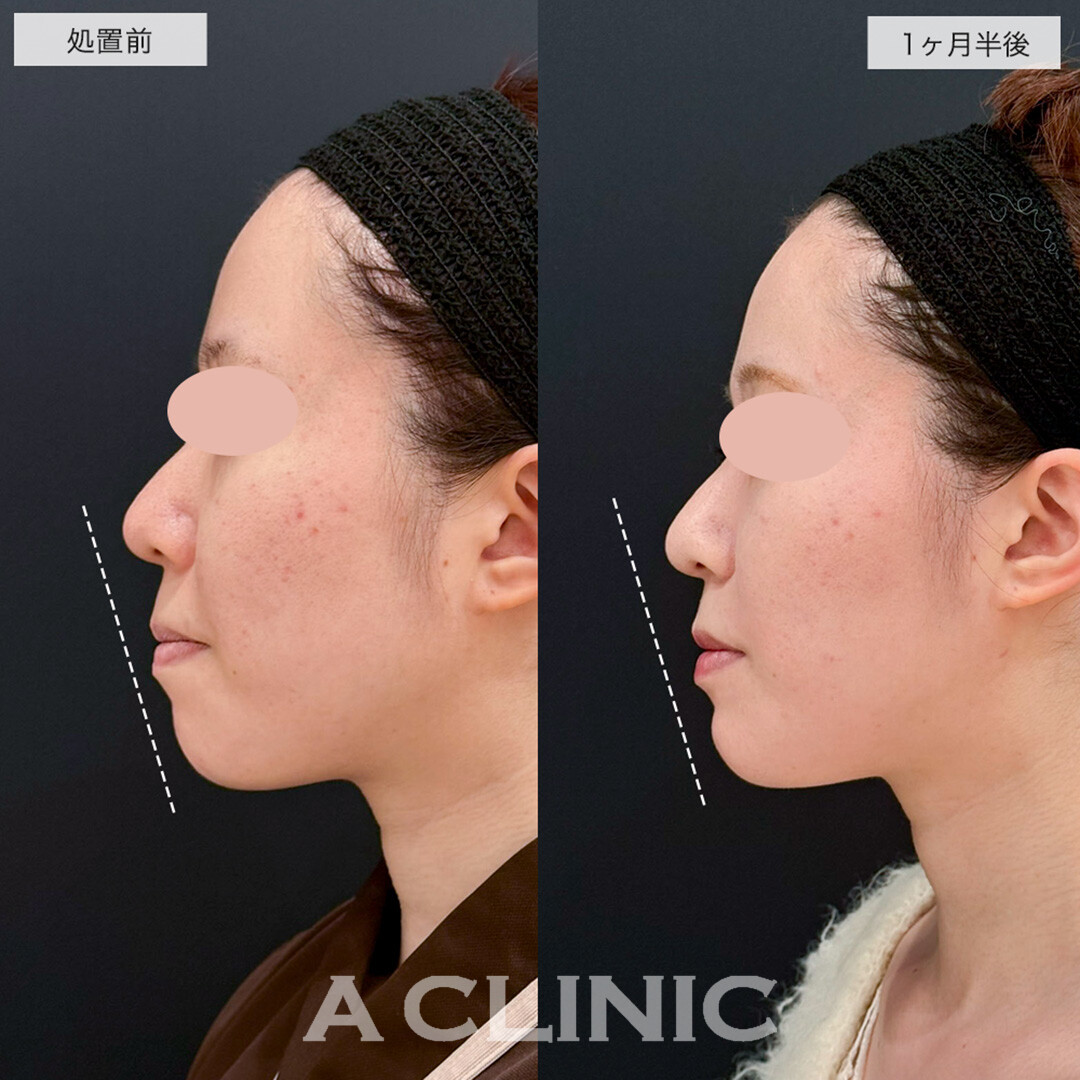 1day小顔脂肪吸引とあごへのヒアルロン酸注入で品よくスッキリした輪郭に!こちら処置前と1ヶ月半後の症例です(20代女性)