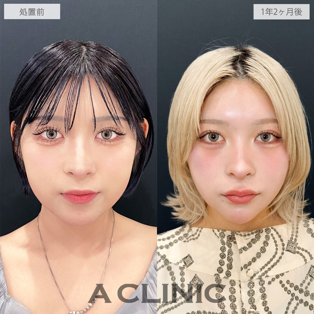 時間が経ってもシャープな輪郭をキープ中！こちら1day小顔脂肪吸引の処置前と1年2ヶ月後の症例です(20代女性)