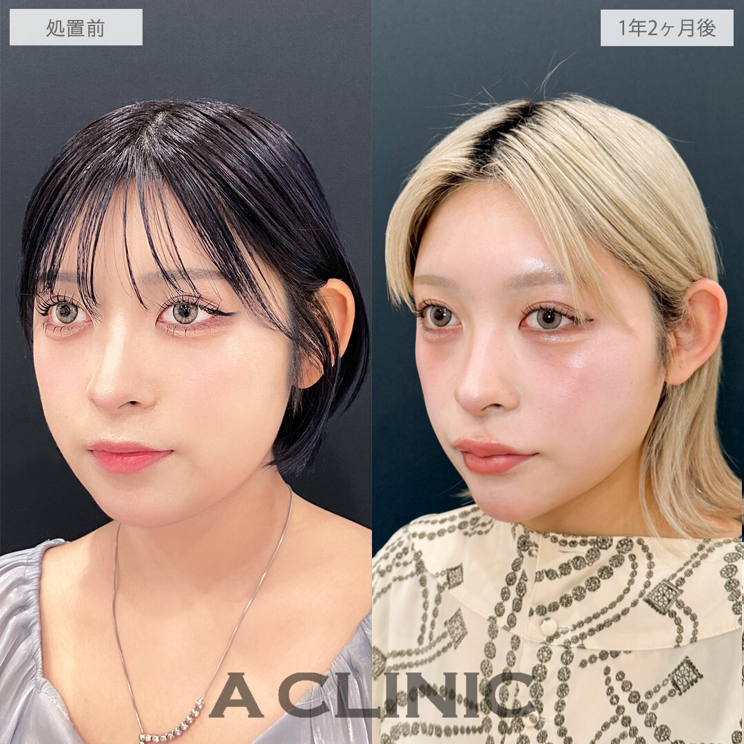 時間が経ってもシャープな輪郭をキープ中！こちら1day小顔脂肪吸引の処置前と1年2ヶ月後の症例です(20代女性)