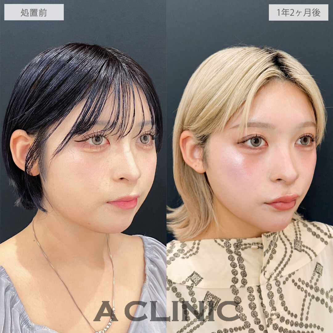 時間が経ってもシャープな輪郭をキープ中！こちら1day小顔脂肪吸引の処置前と1年2ヶ月後の症例です(20代女性)