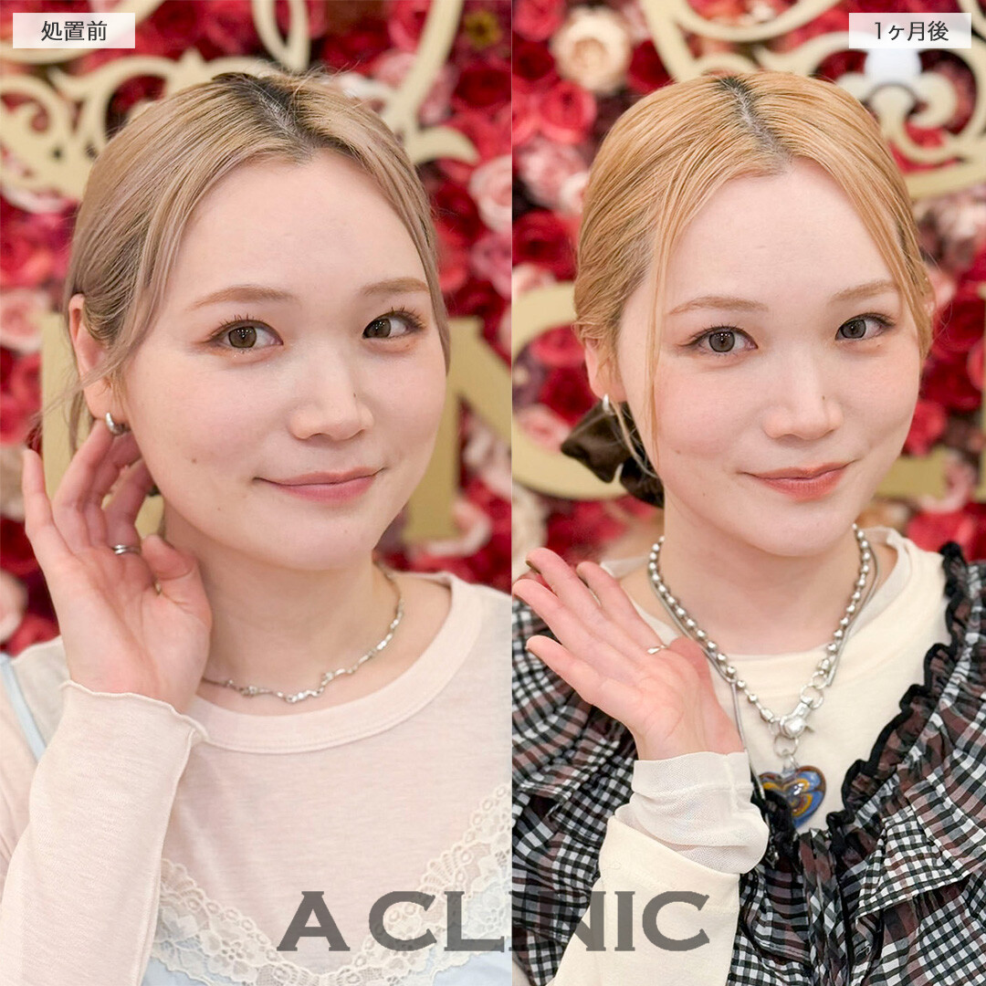 1day小顔脂肪吸引で下を向いた時の二重顎が無くなりました！処置前と1ヶ月後の症例です(30代女性)