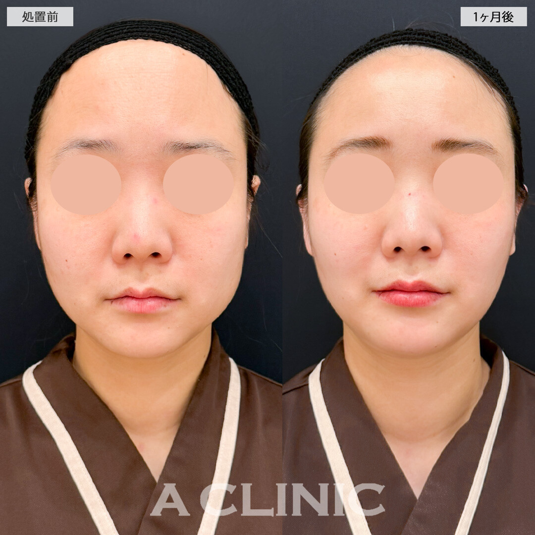 1day小顔脂肪吸引とバッカルファット除去術と小顔エラボトックスで小顔になりスタイル全体のバランスも整いました！処置前と1ヶ月後の症例です(30代女性)