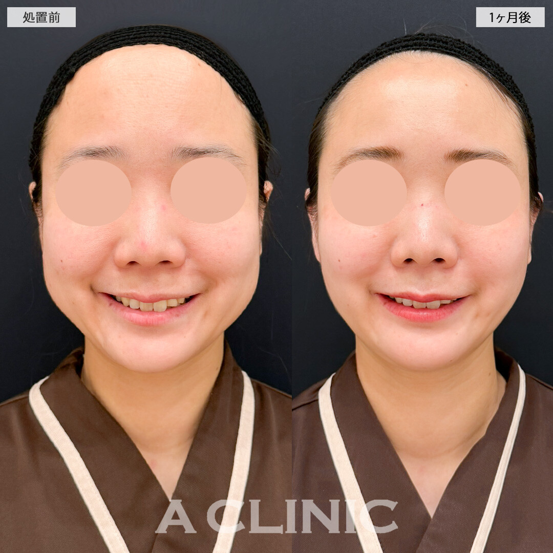 1day小顔脂肪吸引とバッカルファット除去術と小顔エラボトックスで小顔になりスタイル全体のバランスも整いました！処置前と1ヶ月後の症例です(30代女性)
