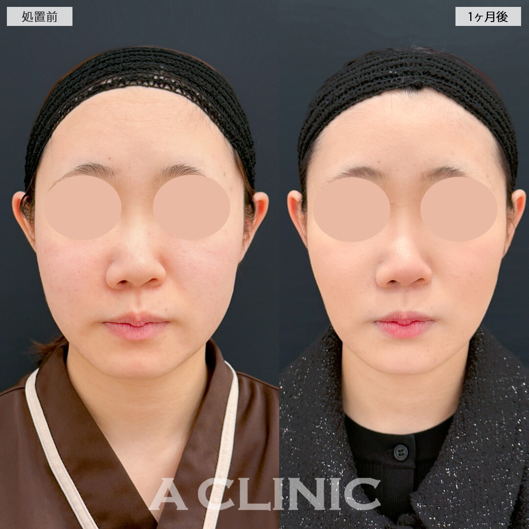 1day小顔脂肪吸引と小顔エラボトックスとあごへのヒアルロン酸注入でどこから見られても恥ずかしくないシャープな輪郭になりました！処置前と1ヶ月後の症例です(10代女性)