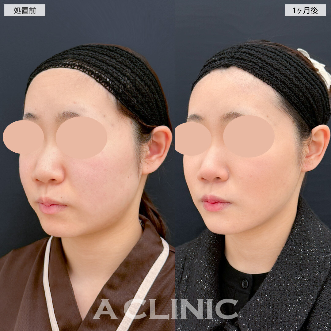 1day小顔脂肪吸引と小顔エラボトックスとあごへのヒアルロン酸注入でどこから見られても恥ずかしくないシャープな輪郭になりました！処置前と1ヶ月後の症例です(10代女性)