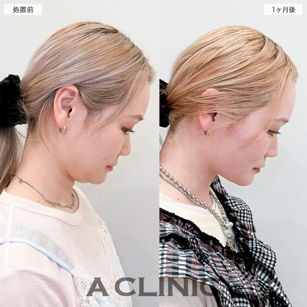 1day小顔脂肪吸引で下を向いた時の二重顎が無くなりました！処置前と1ヶ月後の症例です(30代女性)