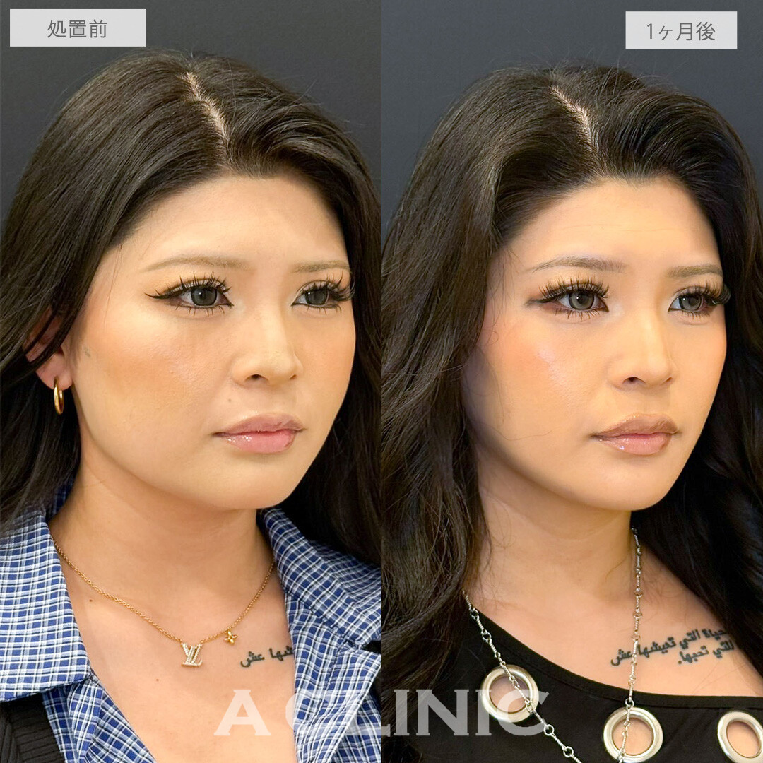 1day小顔脂肪吸引で輪郭のへこみが改善しました！こちら処置前と1ヶ月後の症例です(20代女性)