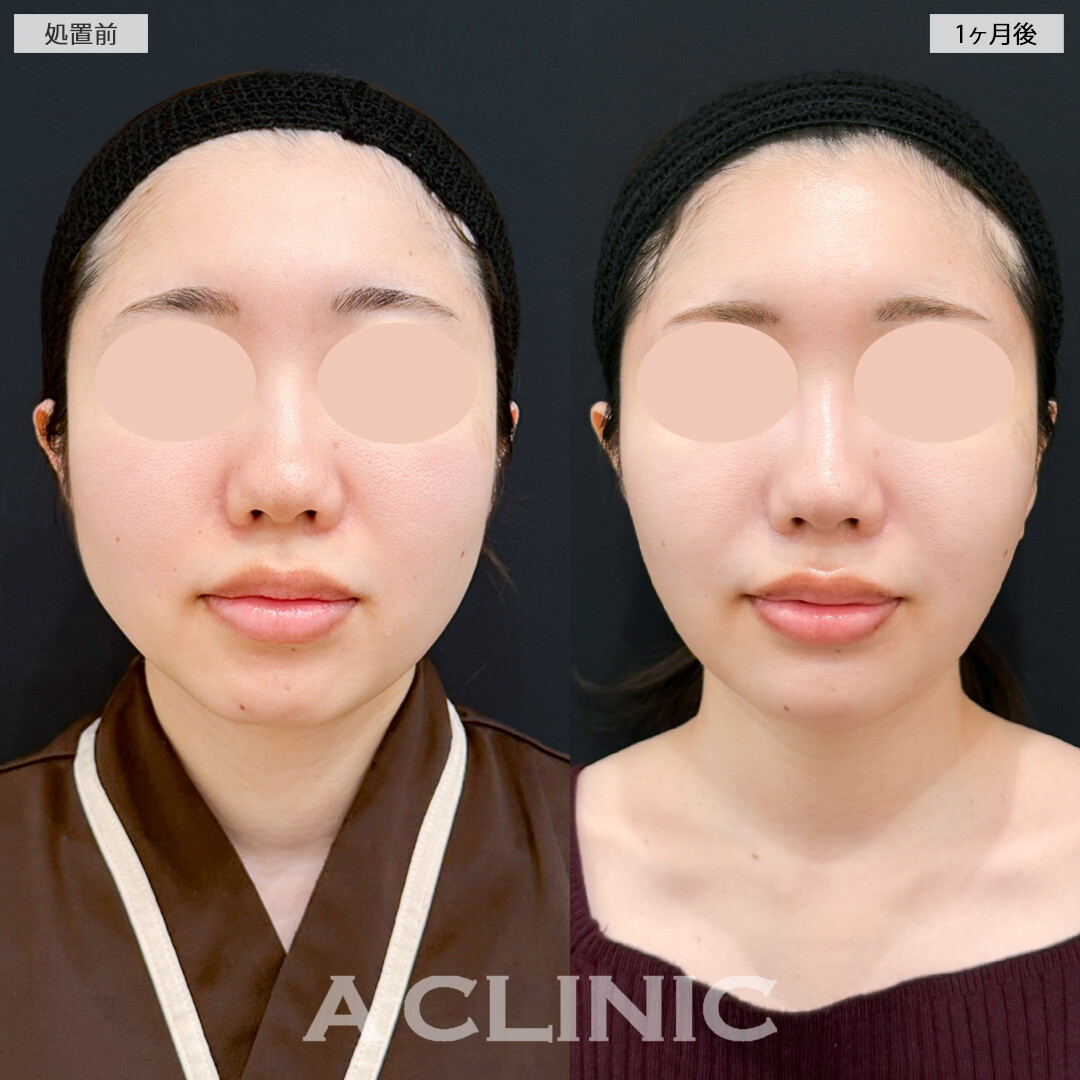 ナゾラビアルファット除去術とバッカルファット除去術の複合施術で輪郭を変えてお顔の印象アップデート！処置前と1ヶ月後の症例です(20代女性)
