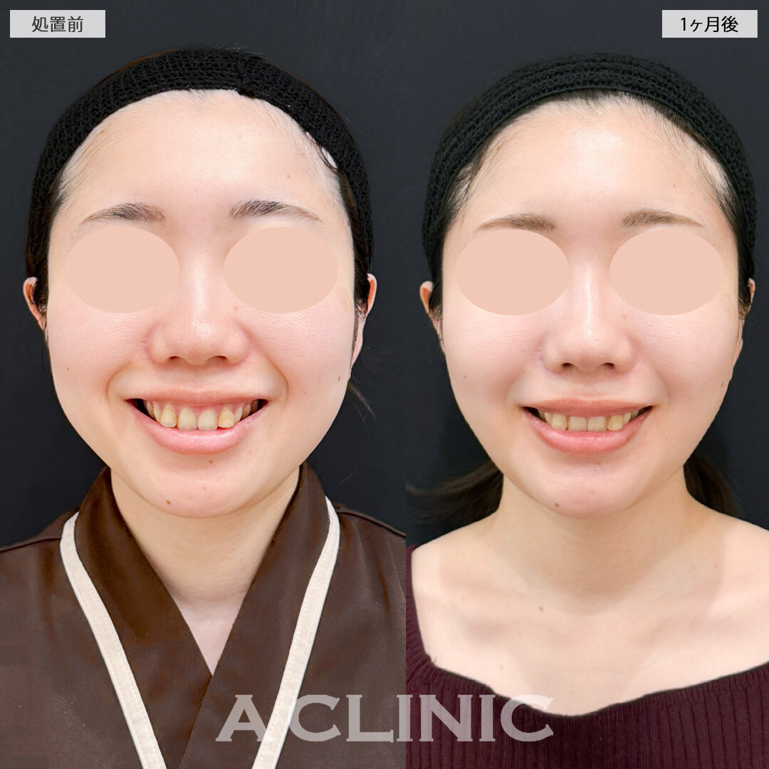 ナゾラビアルファット除去術とバッカルファット除去術の複合施術で輪郭を変えてお顔の印象アップデート！処置前と1ヶ月後の症例です(20代女性)