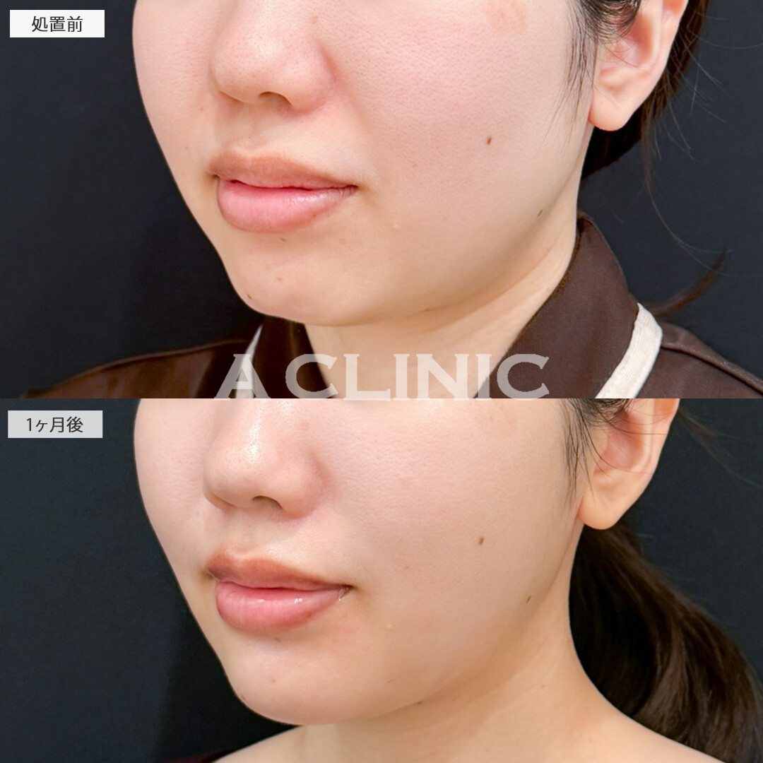 ナゾラビアルファット除去術とバッカルファット除去術の複合施術で輪郭を変えてお顔の印象アップデート！処置前と1ヶ月後の症例です(20代女性)