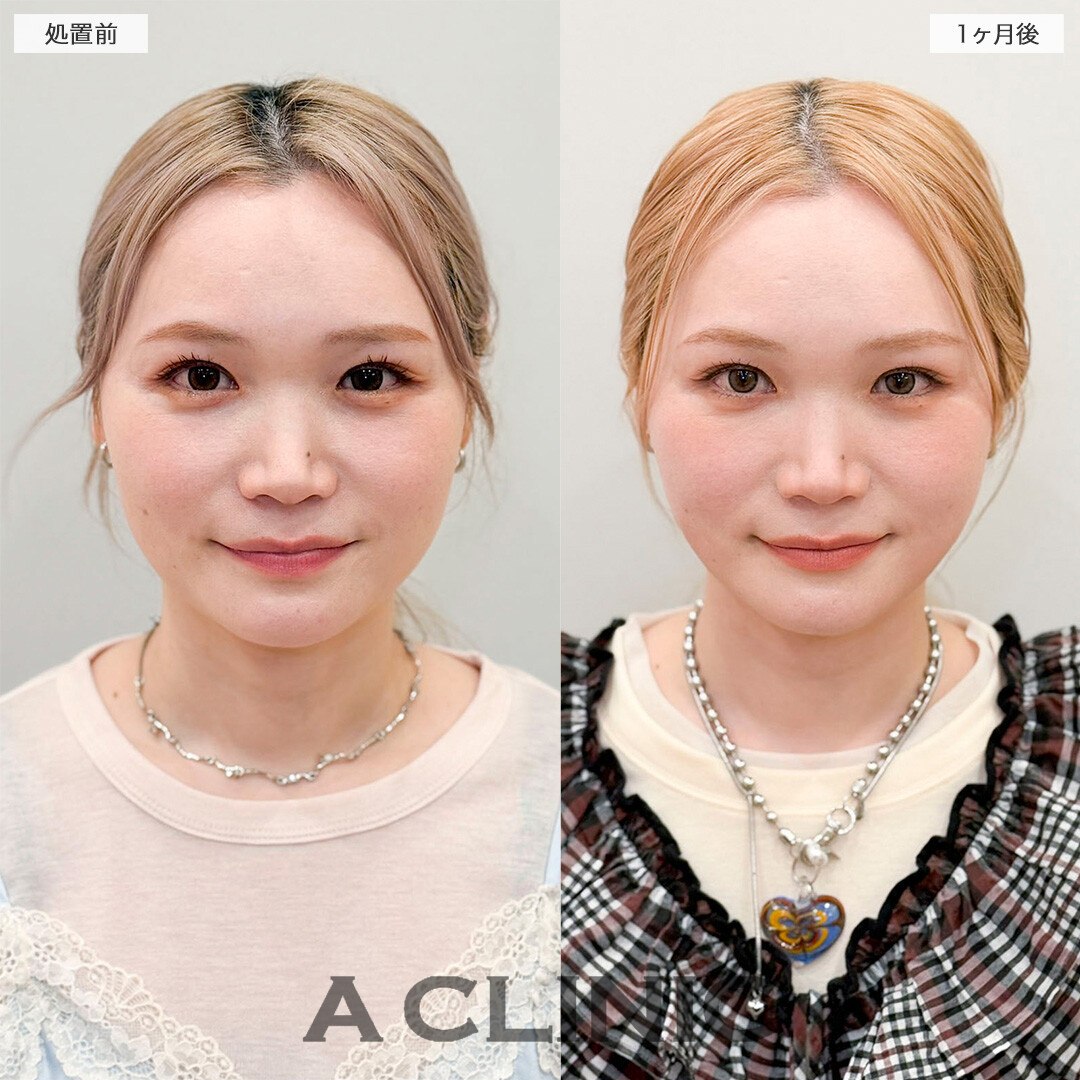 1day小顔脂肪吸引で下を向いた時の二重顎が無くなりました！処置前と1ヶ月後の症例です(30代女性)