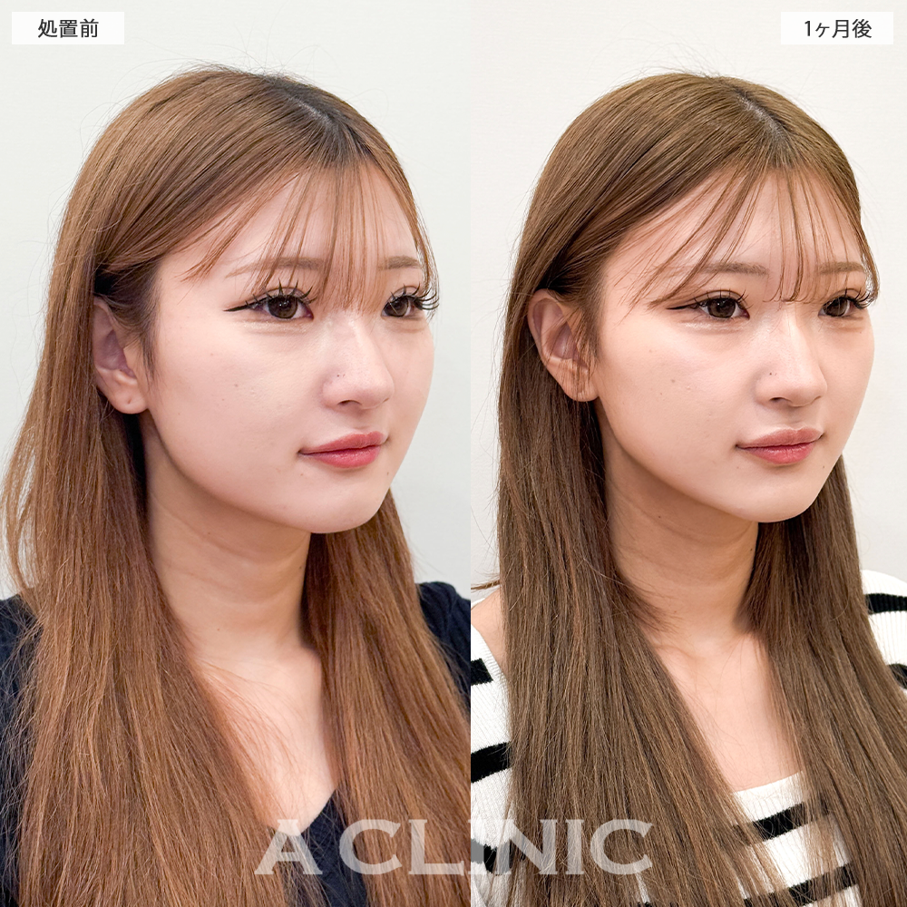 1day小顔脂肪吸引で顔のもたつきが解消されて自然に垢抜け！こちら処置前と1ヶ月後の症例です(20代女性)