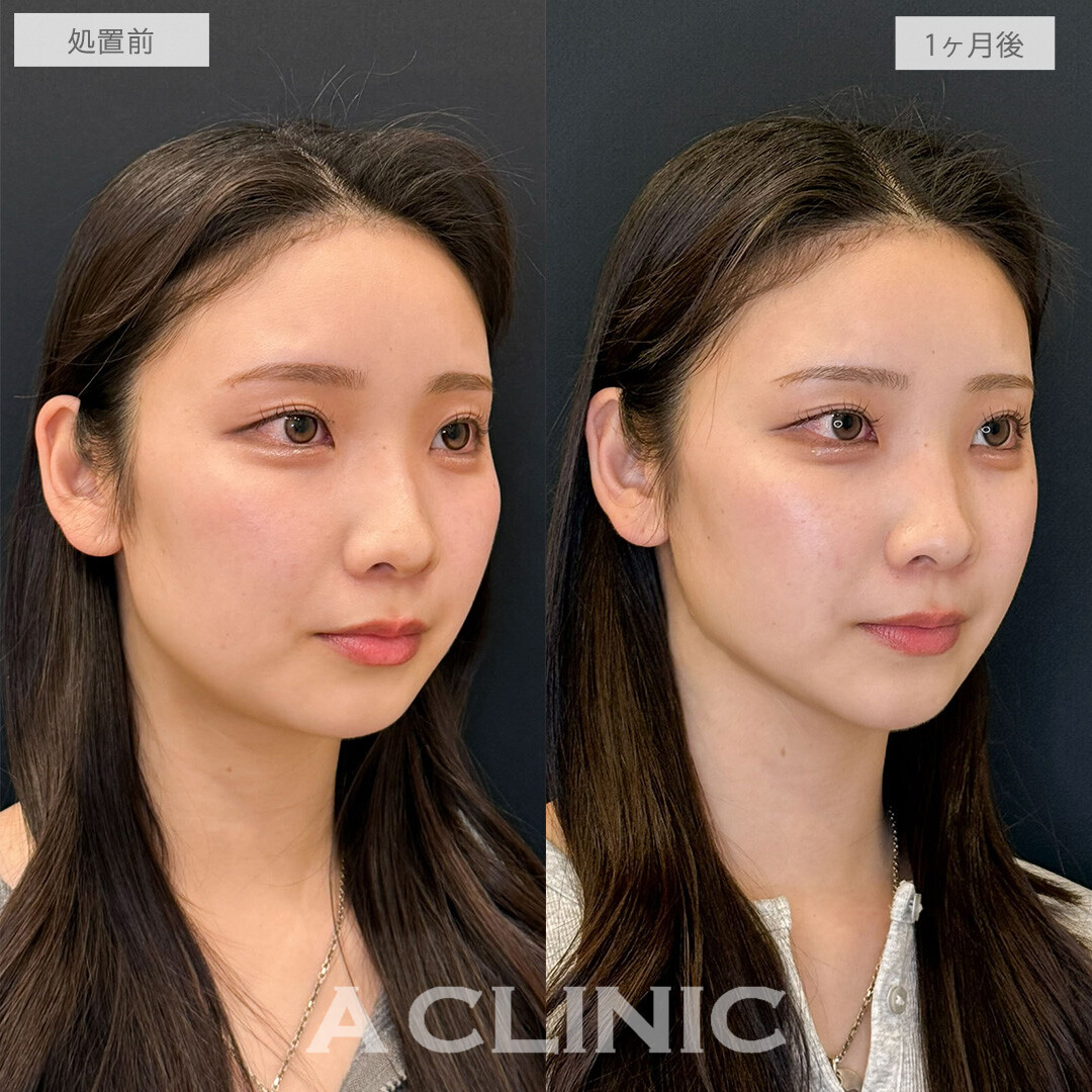 1day小顔脂肪吸引で輪郭に自信がつきました！こちら処置前と1ヶ月後の症例です(20代女性)