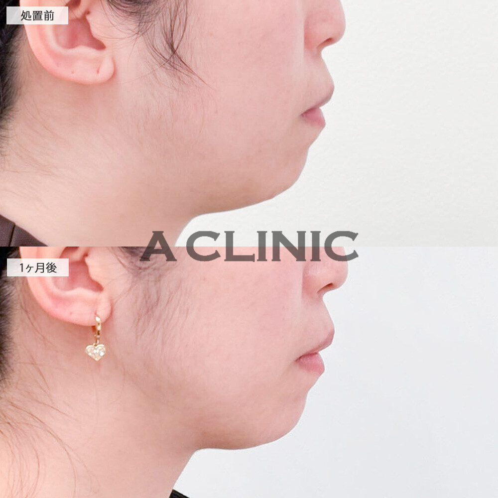 1day小顔脂肪吸引であご下のぷにぷに撃退！処置前から3ヶ月後の症例です(30代女性)