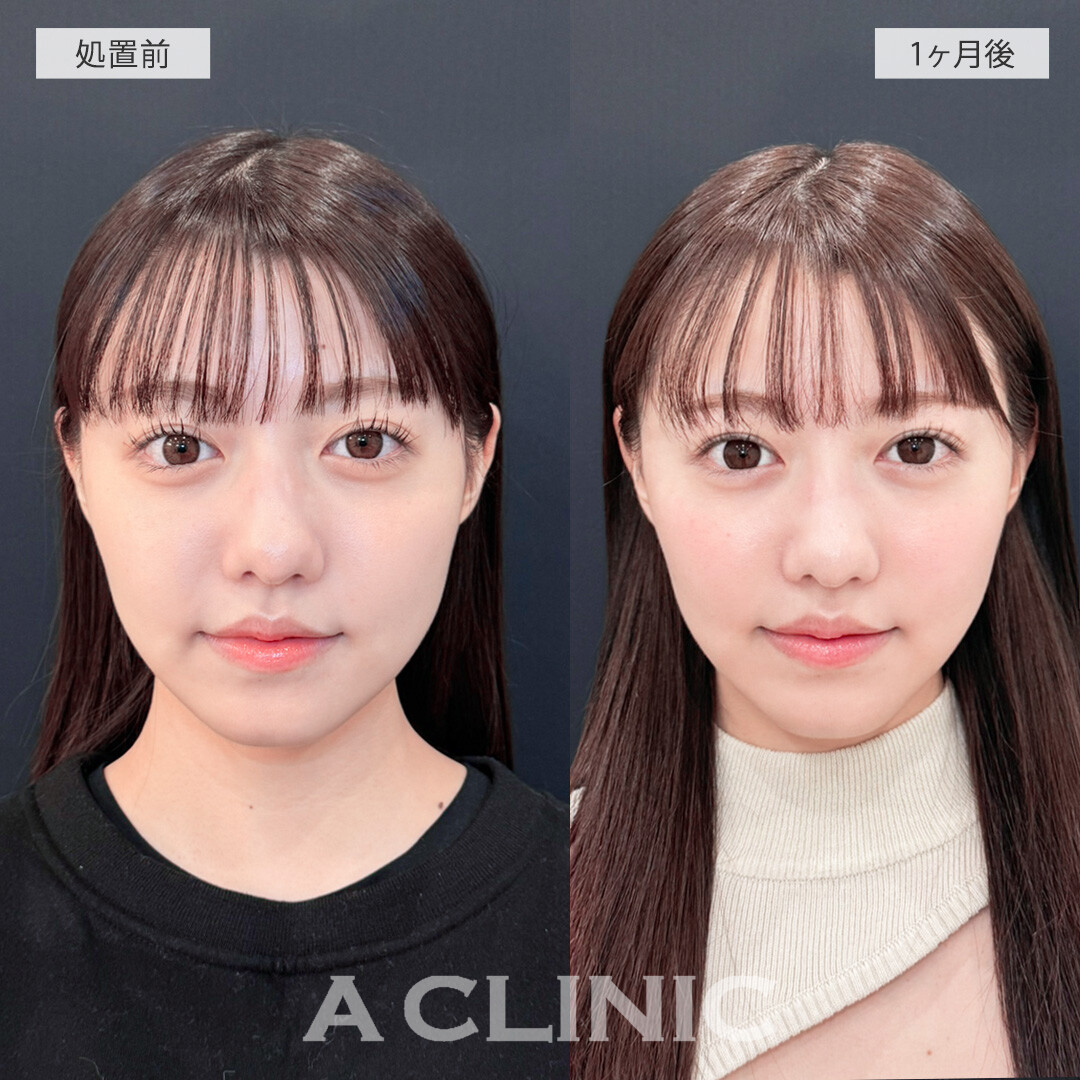 1day小顔脂肪吸引ならダウンタイム最小限でフェイスラインくっきり！こちら処置前と1ヶ月後の症例です(20代女性)