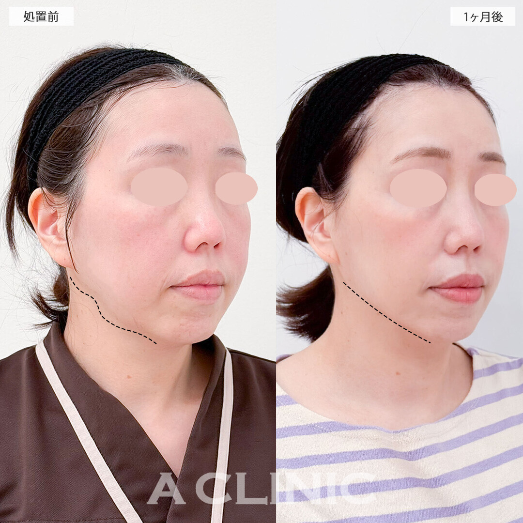 1day小顔脂肪吸引と小顔エラボトックスで自然に若返り！処置前1ヶ月後の症例です(40代女性)