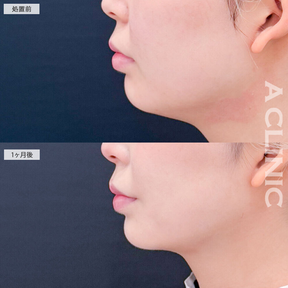 1day小顔脂肪吸引と小顔エラボトックスでしっかり小顔に変化！処置前と1ヶ月後の症例です(20代女性)
