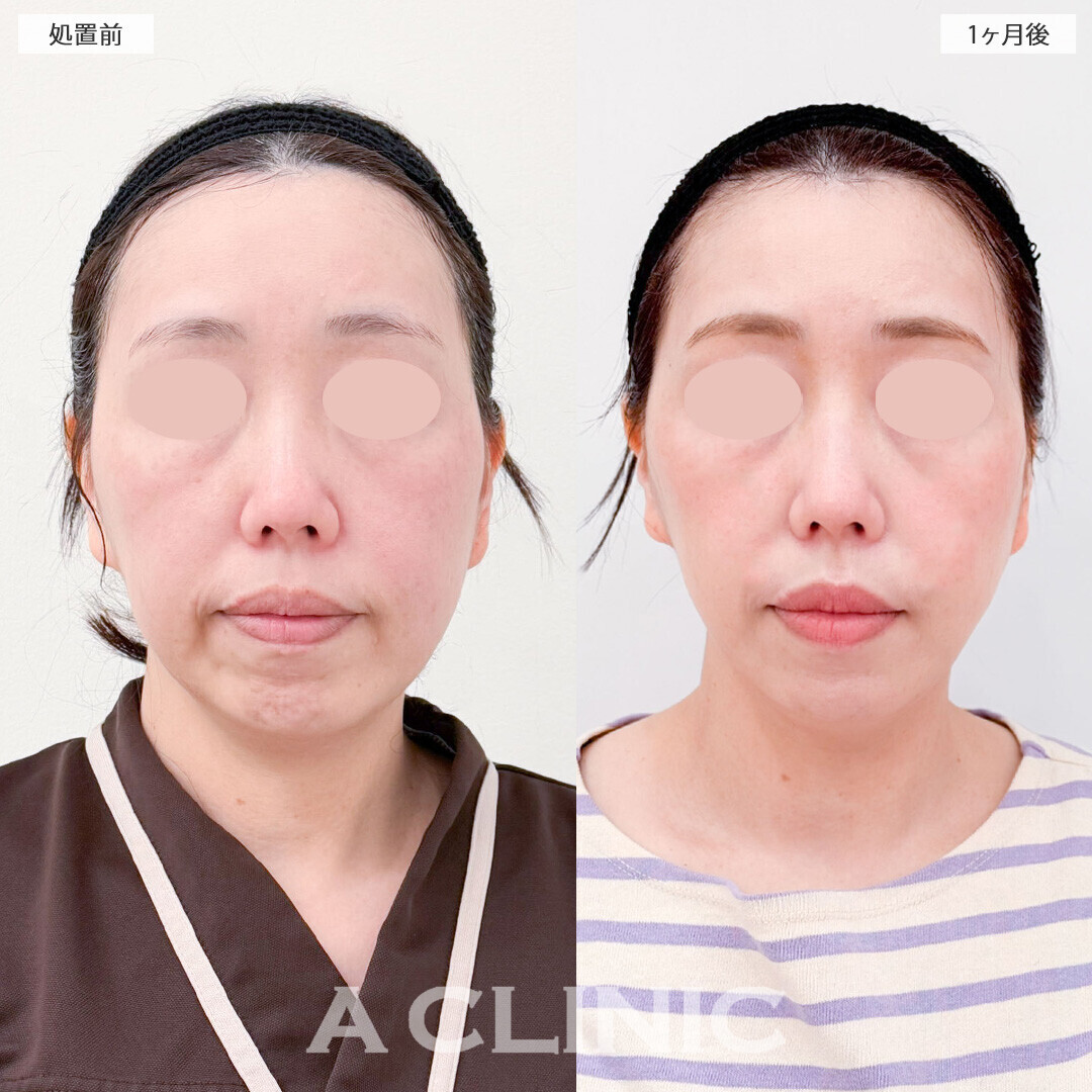 1day小顔脂肪吸引と小顔エラボトックスで自然に若返り！処置前1ヶ月後の症例です(40代女性)