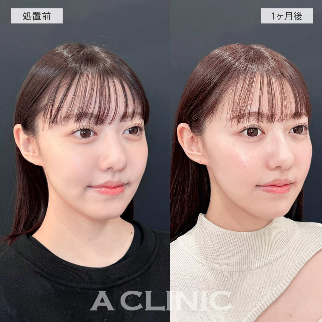 1day小顔脂肪吸引ならダウンタイム最小限でフェイスラインくっきり！こちら処置前と1ヶ月後の症例です(20代女性)