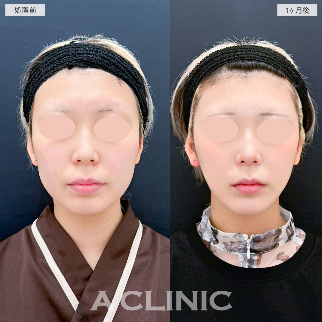 1day小顔脂肪吸引と小顔エラボトックスでしっかり小顔に変化！処置前と1ヶ月後の症例です(20代女性)