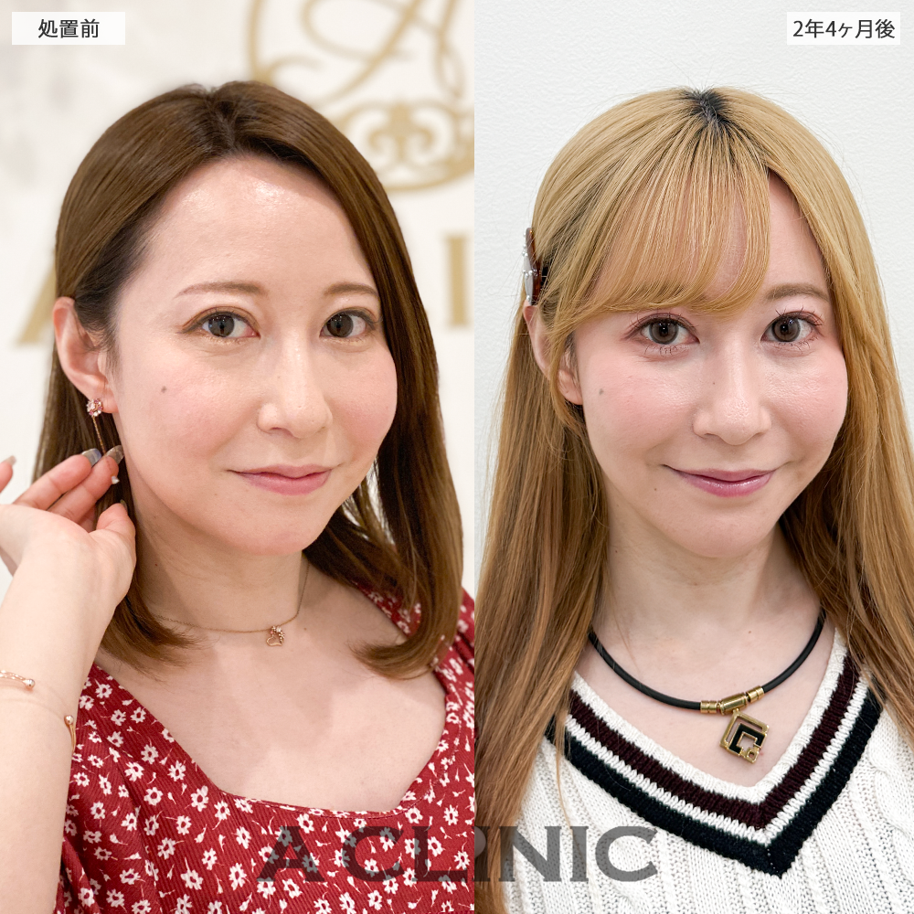 1day小顔脂肪吸引なら長期経過後も美しい輪郭をキープ！処置前と2年4ヶ月後の症例です(30代女性)