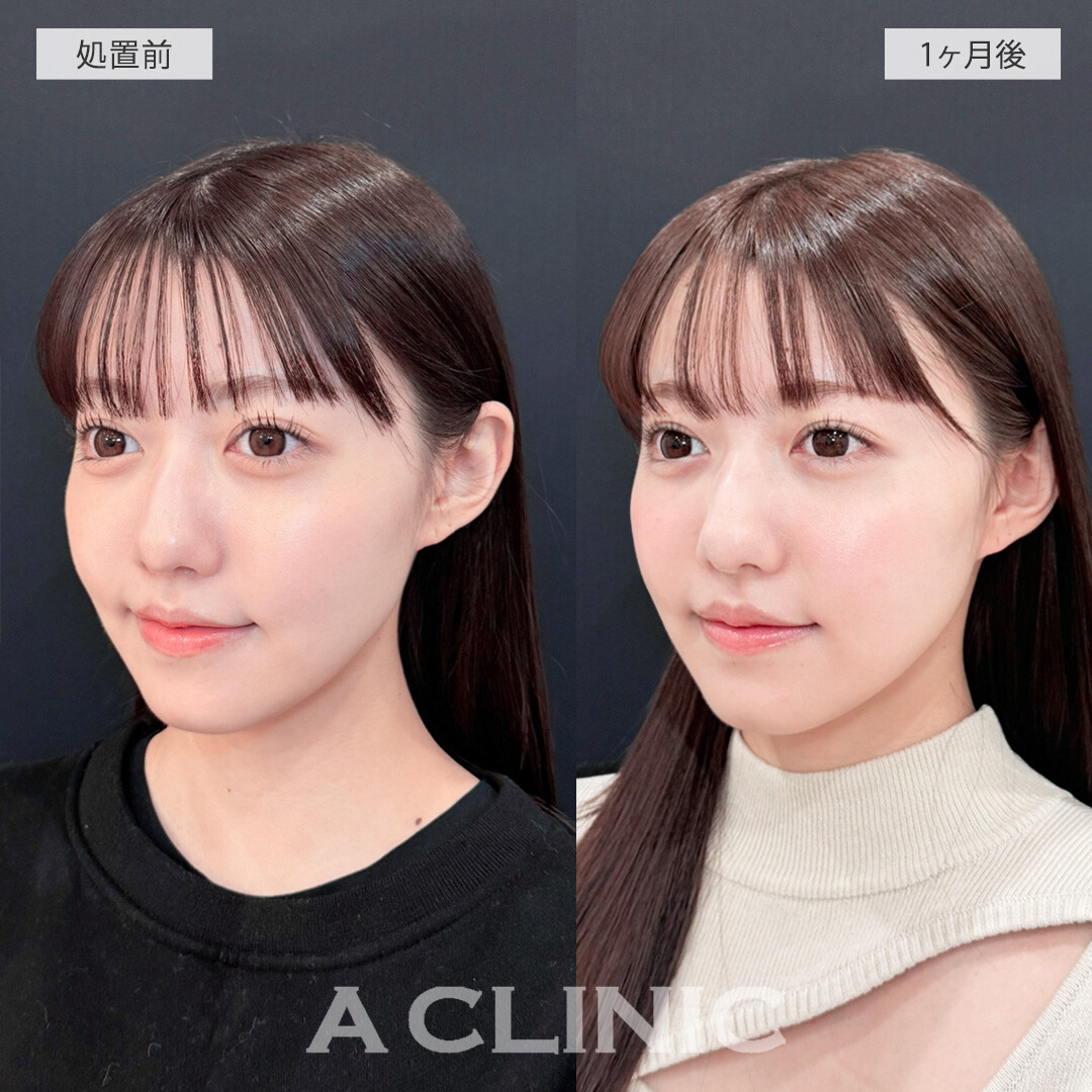 1day小顔脂肪吸引ならダウンタイム最小限でフェイスラインくっきり！こちら処置前と1ヶ月後の症例です(20代女性)