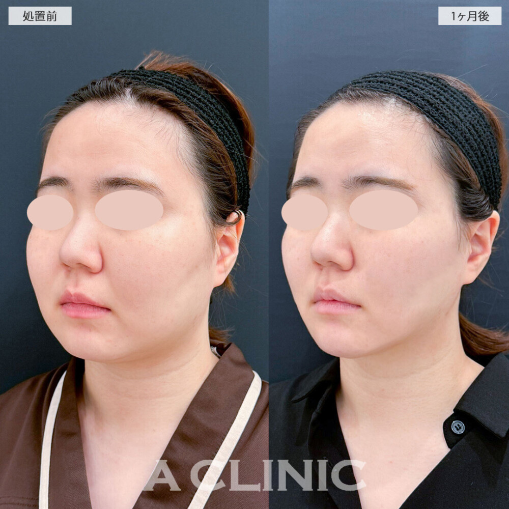 1day小顔脂肪吸引とバッカルファット除去術でどこから見てもひと回り小顔に！処置前と1ヶ月後の症例です(20代女性)