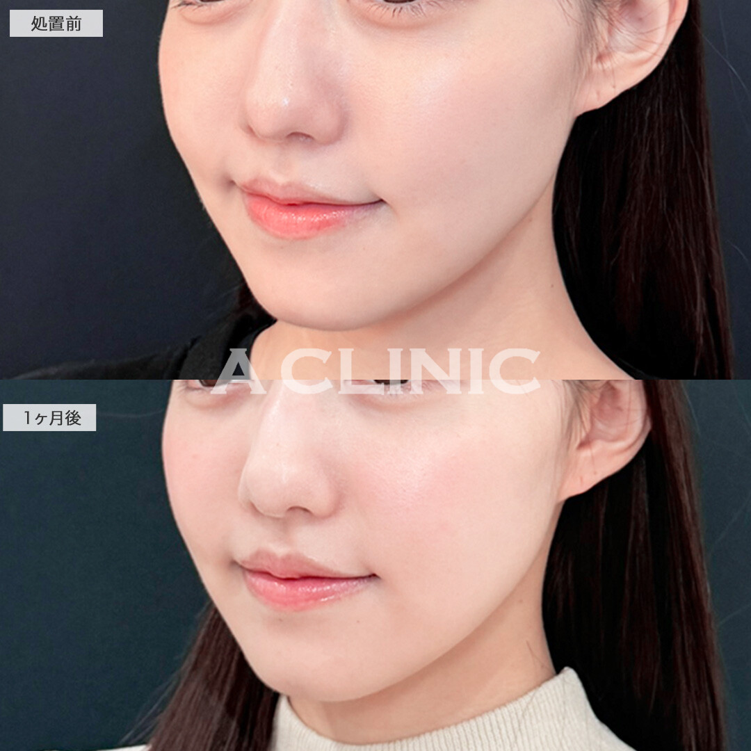 1day小顔脂肪吸引ならダウンタイム最小限でフェイスラインくっきり！こちら処置前と1ヶ月後の症例です(20代女性)